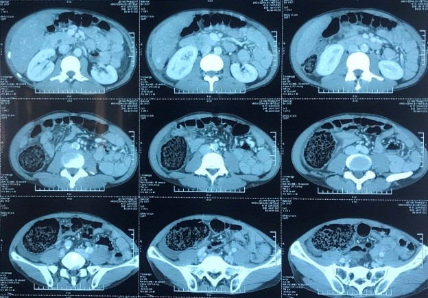 Phẫu thuật thành công cho người bệnh giả tắc đại tràng hiếm gặp